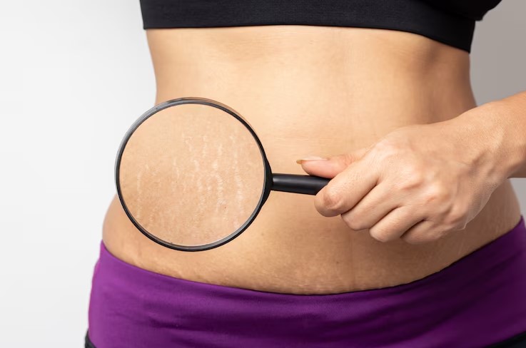 Guide on How to Banish Stretch Marks - Discover Effective Removal Solutions